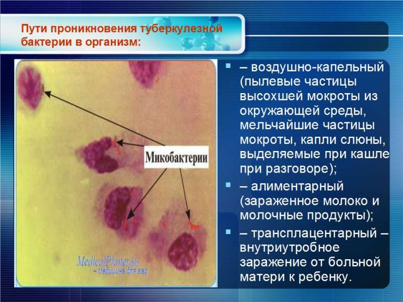 Лекция туберкулез - 05.jpg